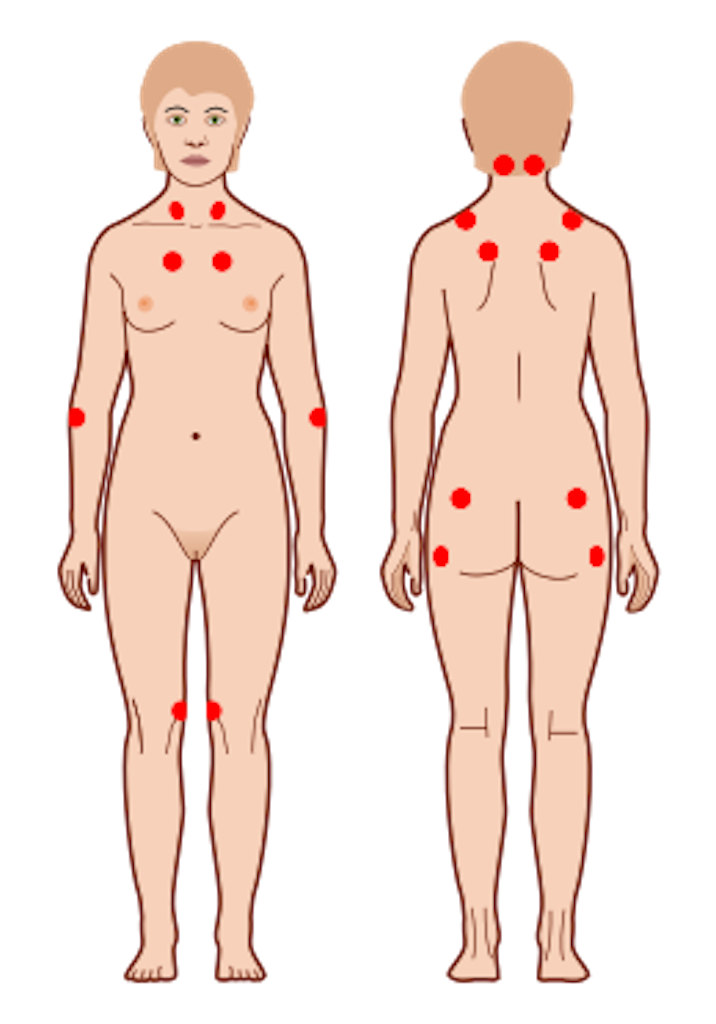 Fibromyalgie_Pierre_Franchomme_lab